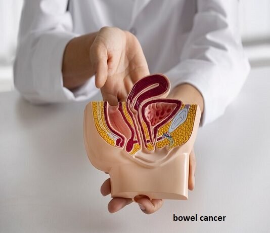 A person holds a medical model of the human digestive system, highlighting the intestines with the text "Bowel Cancer Diagnosis" clearly visible.